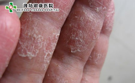 老年手足癣治疗,怎样治疗老年手足癣