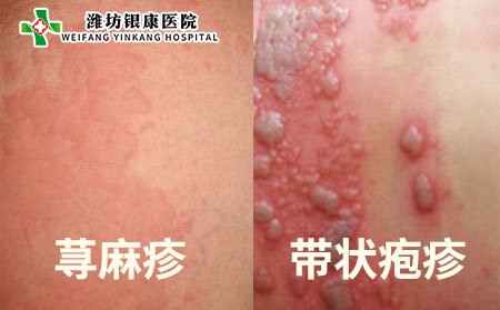 分辨出带状疱疹和荨麻疹
