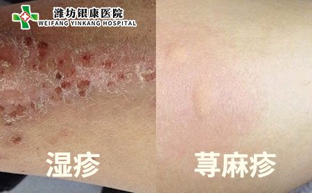 湿疹和荨麻疹的区别图片