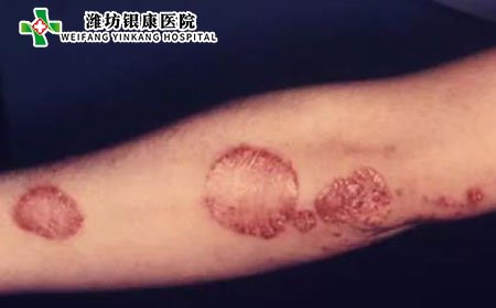 银屑病好转6大征兆,银屑病好转的症状