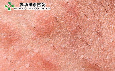 丘疹性荨麻疹能自愈吗,丘疹性荨麻疹多久自愈