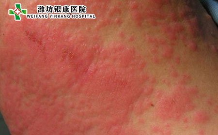 湿疹病因,女性为什么得湿疹
