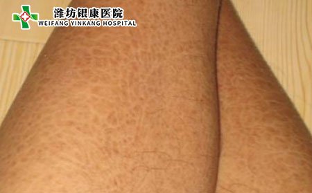 鱼鳞病,鱼鳞病症状,腿部鱼鳞病症状