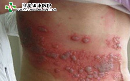带状疱疹,怎样确诊带状疱疹