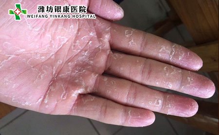 手足癣,怎样预防手足癣