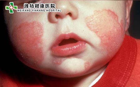 湿疹,如何预防湿疹