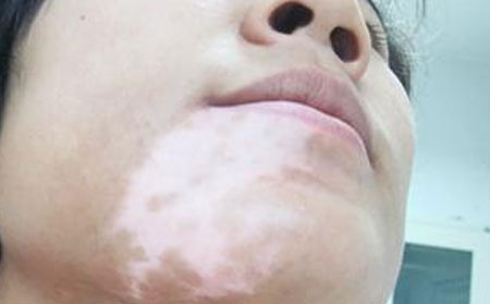 潍坊市正规白癜风医院怎么走,白癜风症状