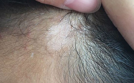 潍坊专家解析微循环障碍引发白癜风