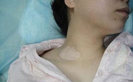 潍坊银康医院专家回答夏季治疗白癜风效果好吗