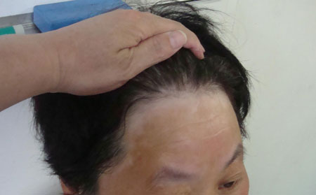 没有家族病史，为什么你还会得白癜风？