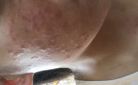 扁平疣为啥不能乱扣
