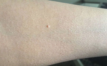 潍坊哪家医院看的冻疮比较在行呢?