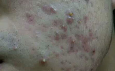 潍坊青春痘的预防和护理