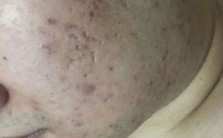轻度痤疮症状都有哪些？
