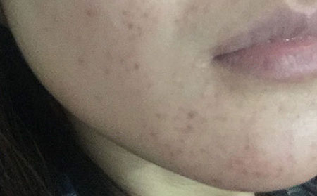 青春痘顽固的原因?