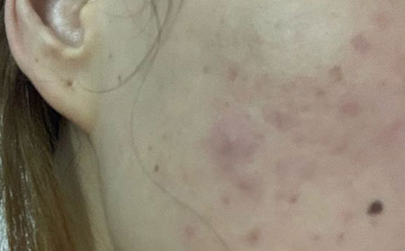 青春痘疾病会有什么样的症状特点