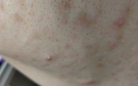 常见痤疮的类型症状有哪些呢?
