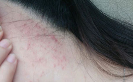 患有痤疮症状有哪些表现呢?