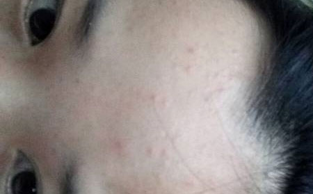 痤疮跟粉刺是一样的吗