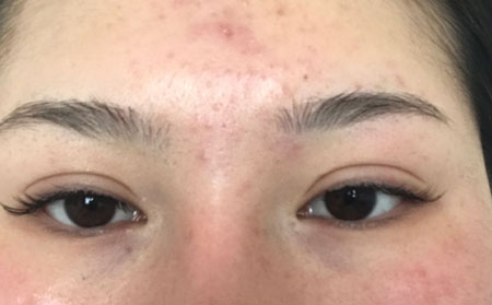 痤疮的类型症状都有哪些呢?