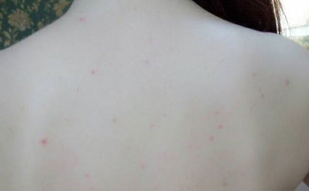 潍坊治痤疮的比较佳的医院_潍坊哪个医院看痤疮好