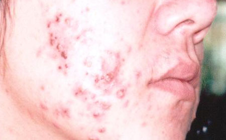 痘痘长在脸上不同部位的成因