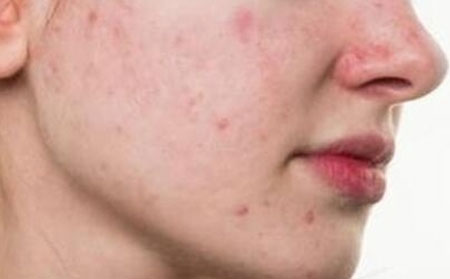 痘痘有哪些危害?要如何护理呢?