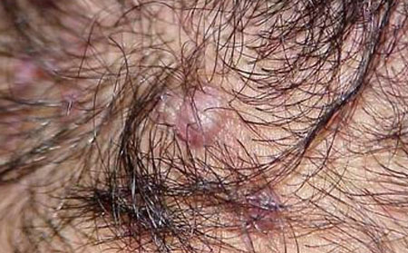 哪些因素会导致人们患上毛囊炎