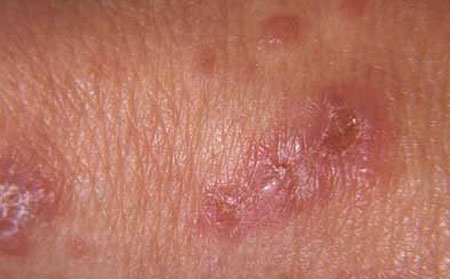 皮肤瘙痒的致病因素是什么