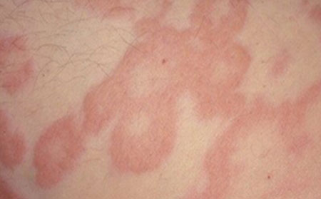 皮肤瘙痒是什么原因导致的