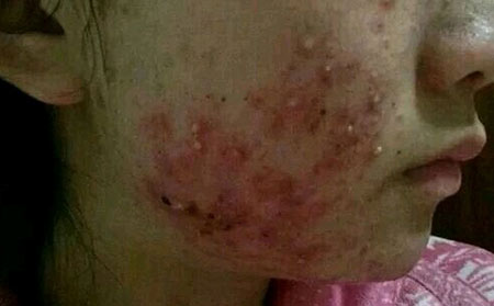 潍坊银康医院解析过敏性皮炎的常见病因