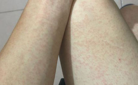 潍坊过敏性皮炎的症状有哪些呢?