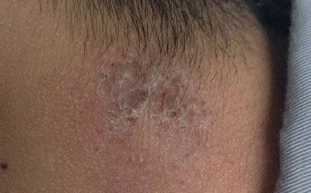 潍坊银康医院解析脸上出现皮炎的原因?