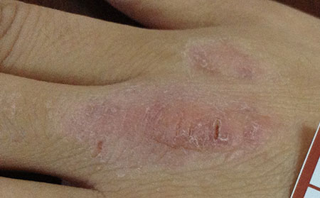 潍坊市地区出现皮炎的原因有哪些