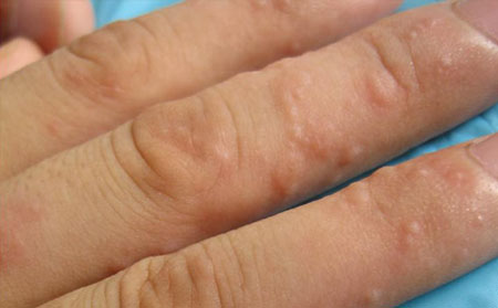 引起接触皮炎的病因是什么?