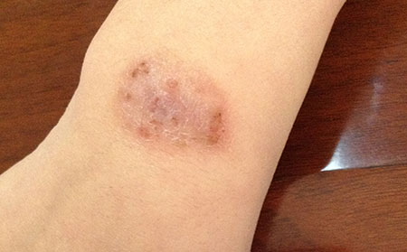 在潍坊市引发湿疹的原因是什么