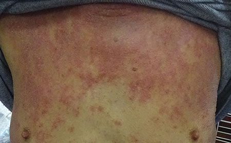 引起湿疹的病因有哪些?