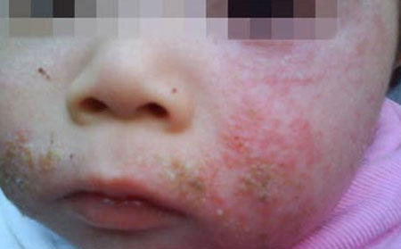 湿疹症状是什么样的?