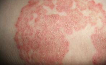 儿童湿疹的症状有哪些？