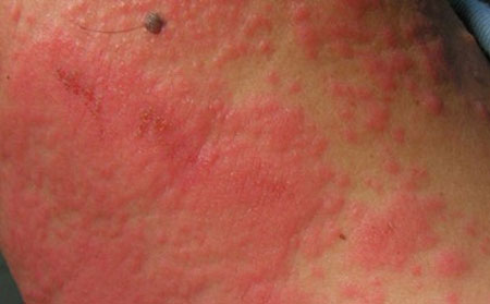 潍坊治疗湿疹需要多少钱呢？