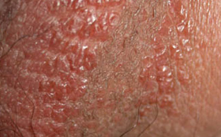 湿疹的常见症状表现有哪些？