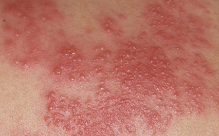 湿疹症状初期的表现有哪些?