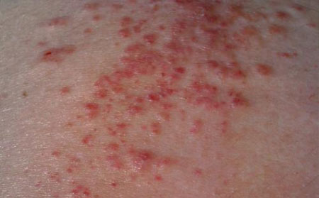 一般湿疹是怎么引起的?