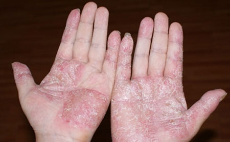 手脱皮什么原因?怎么治疗手脱皮