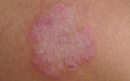 对于体癣我们该怎么样预防呢?