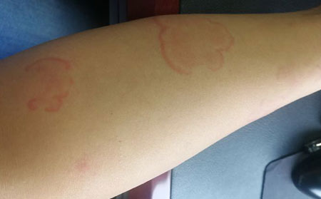 在潍坊市治疗荨麻疹多少钱？