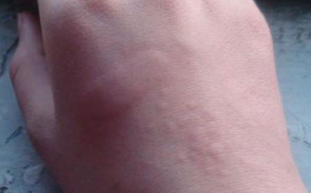 潍坊治疗荨麻疹哪家比较好?4类特殊的荨麻疹治疗要注意