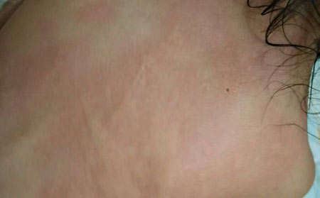 荨麻疹疾病会有哪些症状类型