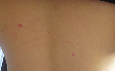 荨麻疹有何症状表现呢?