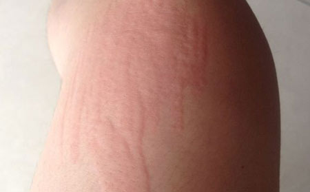 潍坊治疗荨麻疹去哪家医院